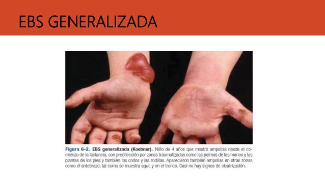 epidermolisis ampollar simple